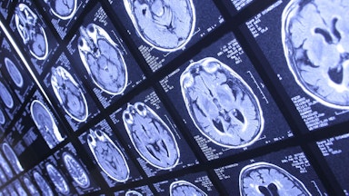 Brain activity scan in medical imaging